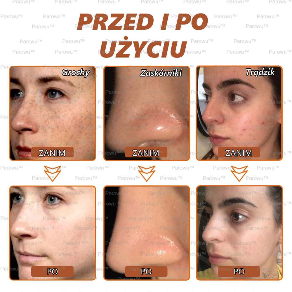 Parowu™ Wybielająca i Rozjaśniająca Maska - Naturalne składniki trwale usuwają plamy, piegi i przebarwienia✅✅✅