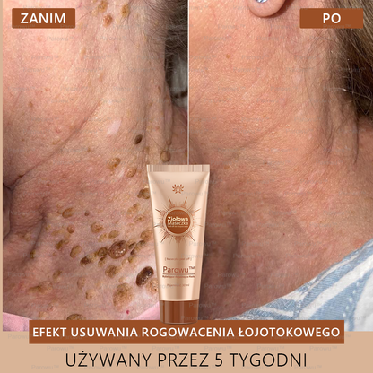 Parowu™ Wybielająca i Rozjaśniająca Maska - Naturalne składniki trwale usuwają plamy, piegi i przebarwienia✅✅✅