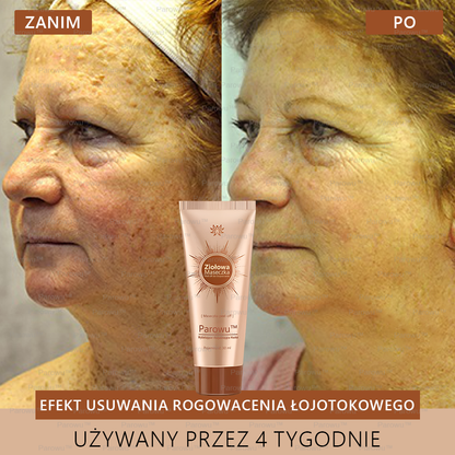 Parowu™ Wybielająca i Rozjaśniająca Maska - Naturalne składniki trwale usuwają plamy, piegi i przebarwienia✅✅✅